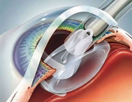 Cataract Recovery