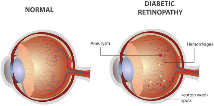 Retina Care